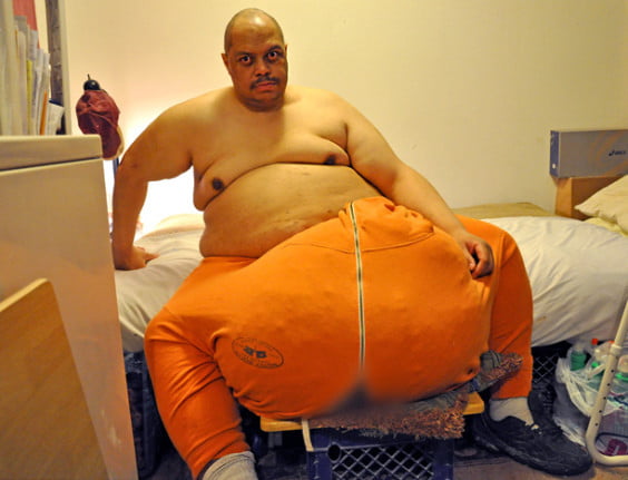 (3) Photos: L’homme aux testicules de 45 kilos est décédé… Regardez