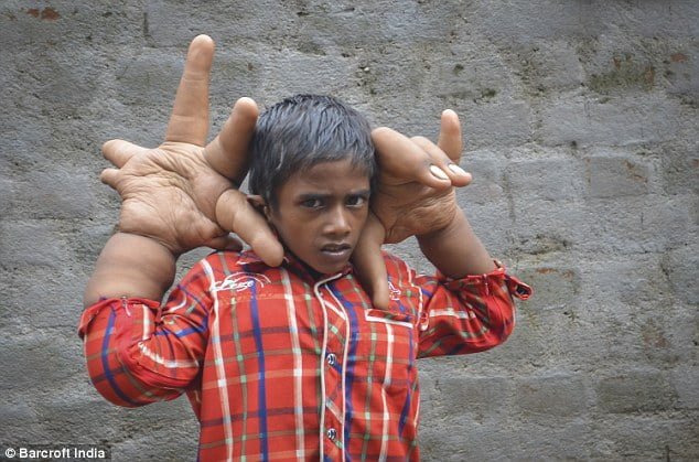 Vidéo + Photos: Avec ses mains gigantesques, ce petit garçon n’a pas la vie facile. Regardez