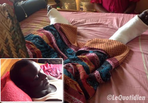 UCAD-Ses deux jambes cassées et grièvement blessé au crâne par des policiers : L’étudiant Diatta Sall raconte l’horreur