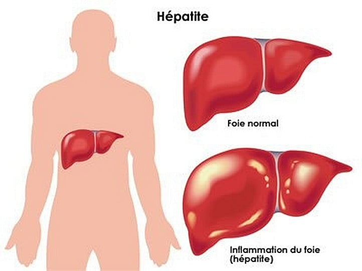 Santé – Touba: Sur 5000 donneurs de sang, 1750 sont affectées par l’hépatite B