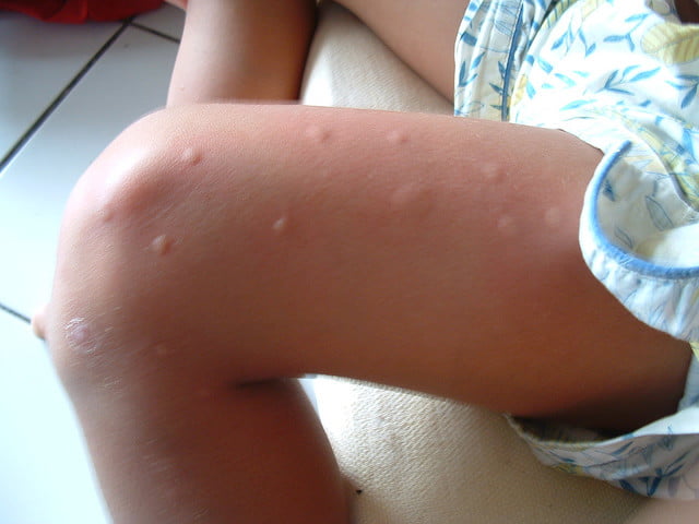 Tous les malades atteints de Chikungunya sont tous guéris à Kédougou