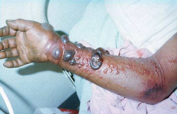 Santé : Un troisième cas de fièvre hémorragique Crimée Congo pris en charge à l’Hôpital Dalal Jamm