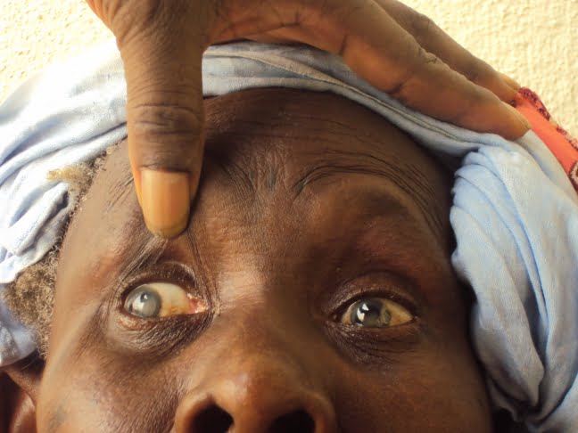 Dr Boubacar Sall, coordonnateur programme santé oculaire :  » il y a 800 000 personnes handicapées visuels dans ce pays « 