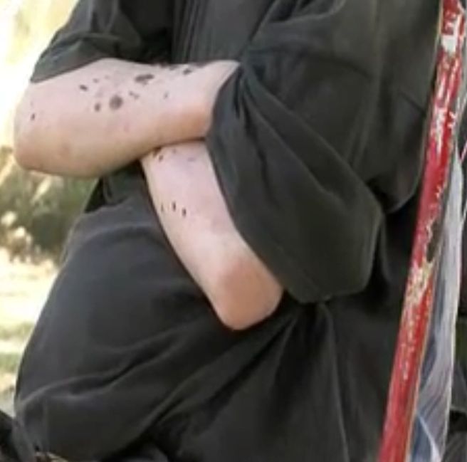 Vidéo: « Malgré son état de grossesse, l’albinos Fatou est souvent victime d’abus sexuels