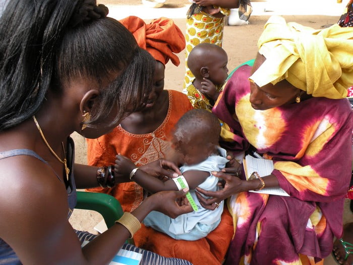 Malnutrition au Sénégal : les enfant en souffrance