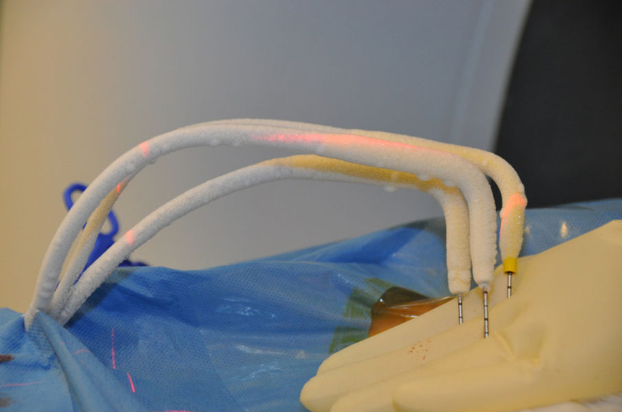 Matar Ba offre une cryothérapie pour dépister le cancer au centre de santé de Fatick