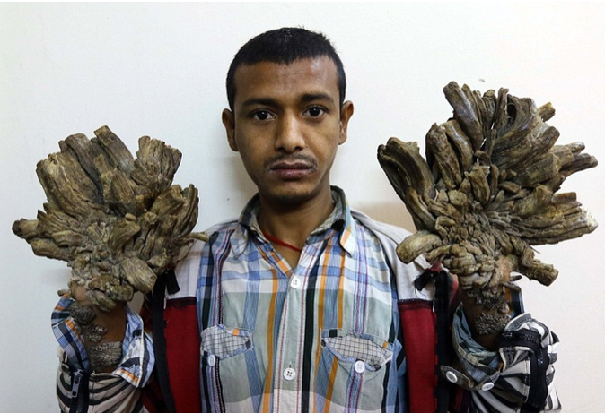 Cette maladie qui transforme les humains en arbre…