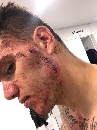 Arrêt sur image: Le visage d’Ederson, le gardien de Man City, après son contact avec Sadio Mané…