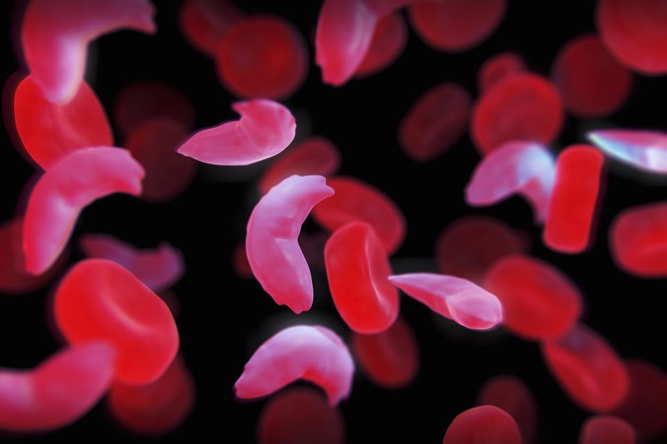 Drépanocytose : première guérison par thérapie génique