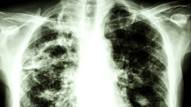 Tuberculose : Diourbel est la deuxième région la plus touchée