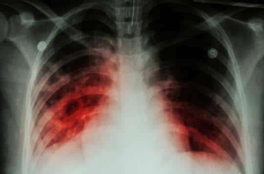 Kolda : Des populations dépistées gratuitement à la tuberculose