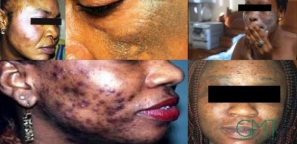 Dépigmentation au Sénégal : taux de prévalence 71%…10 milliards par an…