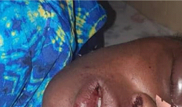 Guédiawaye : Un homme ivre défigure sa femme…(photo)