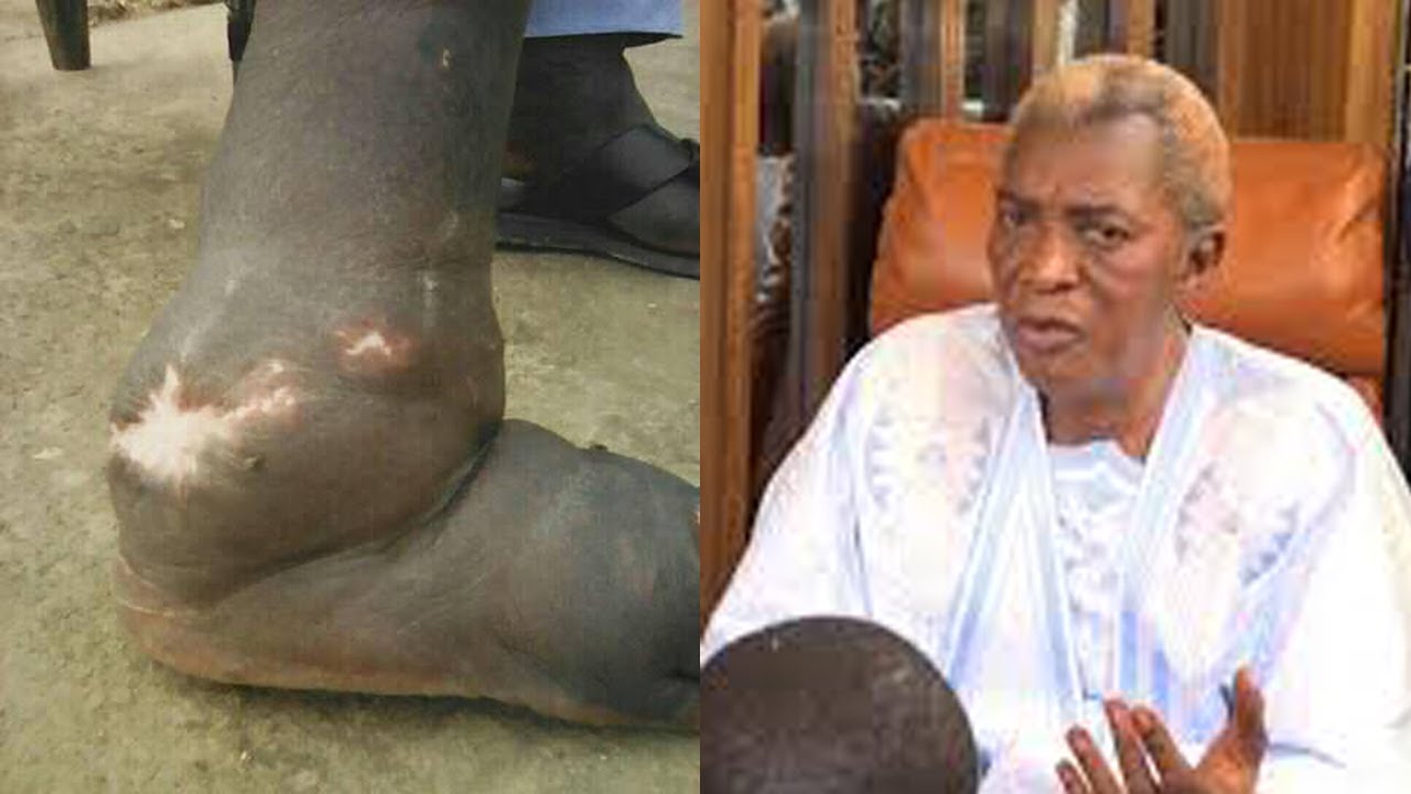 Vidéo-témoignage: « Si mon pied est comme ça, c’est grâce à Serigne Abdou Karim Mbacké. Regardez !