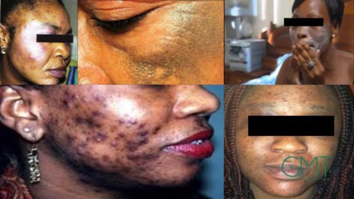 Gambie : Vers l’abrogation d’une loi contre la dépigmentation