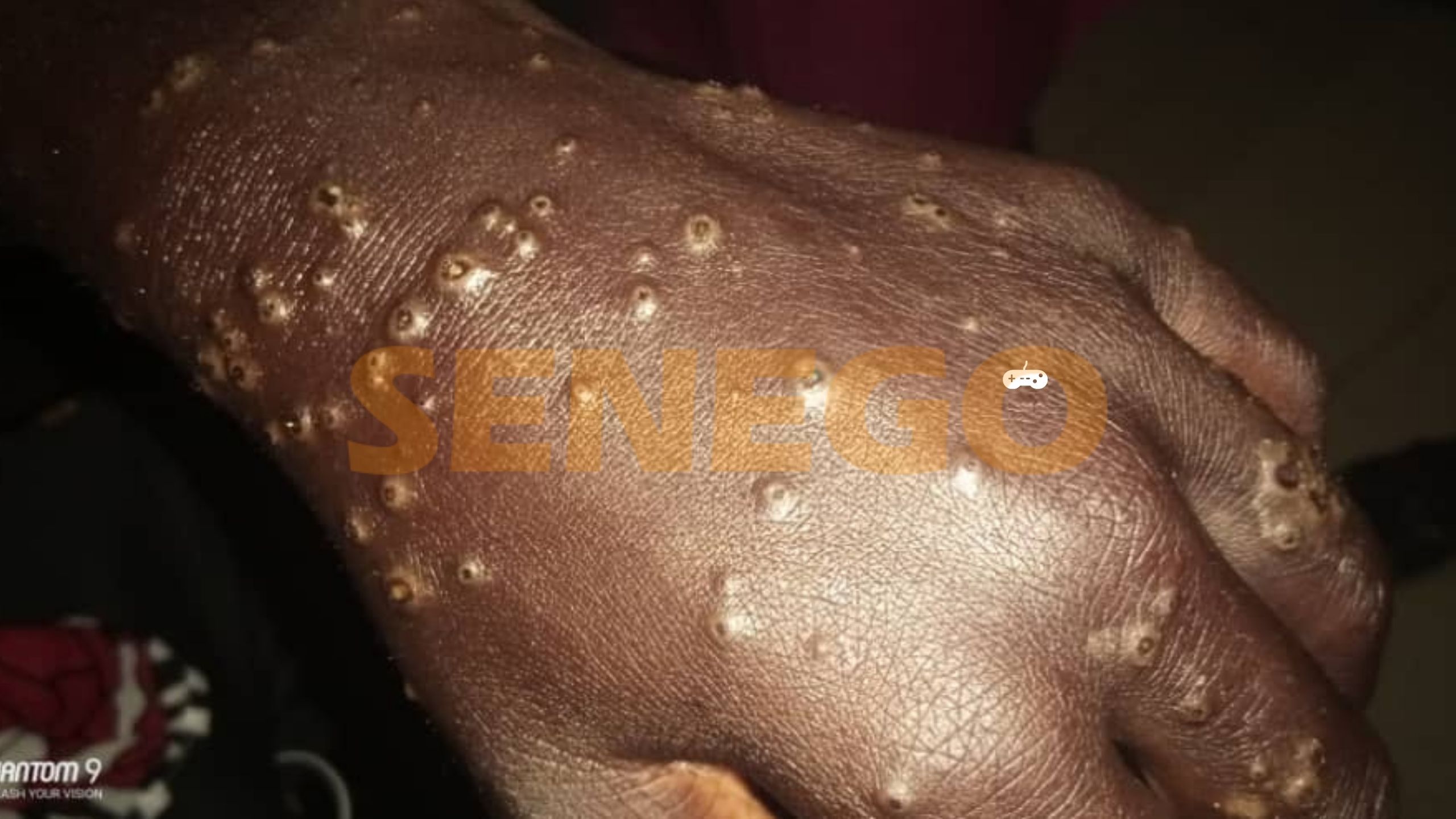 Professeur Mame Thierno Dieng sur la maladie dermique mystérieuse de Thiaroye et alentours