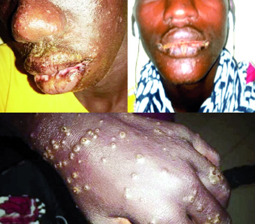 Maladie mystérieuse : 61 nouvelles contaminations à Thiaroye-Sur-Mer