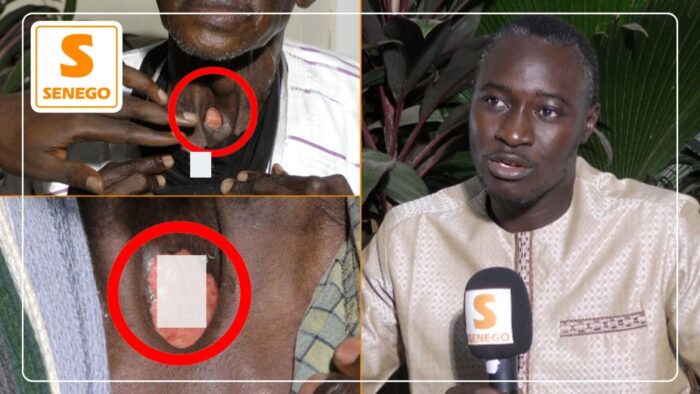 Cette grave maladie qui interpelle les Sénégalais et les autorités étatiques (Senego-TV)