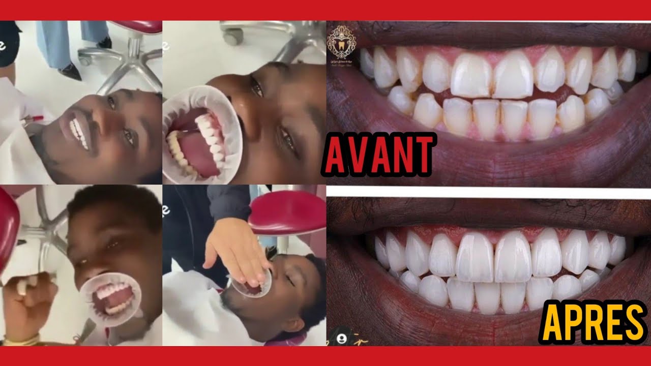(Vidéo) – Wally Seck se refait les dents et dévoile son nouveau sourire