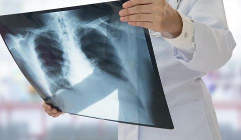 Tuberculose: La maladie a tué 1,5 million de personnes en 2020 (OMS)