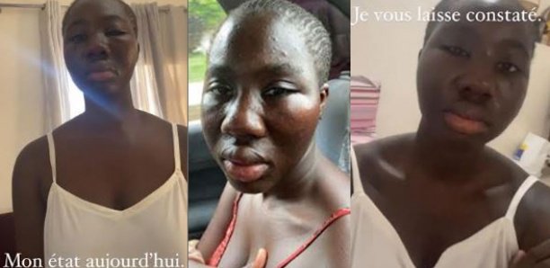 Agression sexuelle présumée de Kaliphone : Le mannequin Adji Diaw montre les coups et blessures (15 photos)