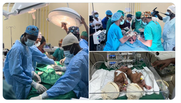 Tchad – Des jumelles siamoises séparées : « Une avancée médicale », Ucad