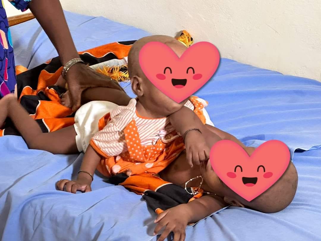 Hôpital d’Enfants Albert Royer de Dakar : Deux bébés siamois séparés avec succès (Photos)