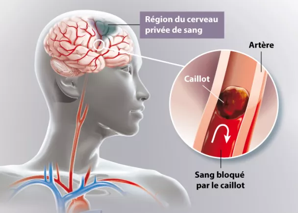 Prise en charge de l’AVC : « Le Sénégal n’a que de 5 lits de réanimation neurologique »