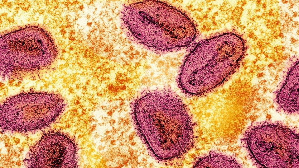 Allemagne : Détection du premier cas du variant mpox clade 1b