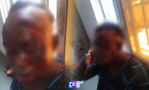 Paléne-Mbacké : Une femme brûlée au visage par la sœur de son époux avec de l’acide chaud…