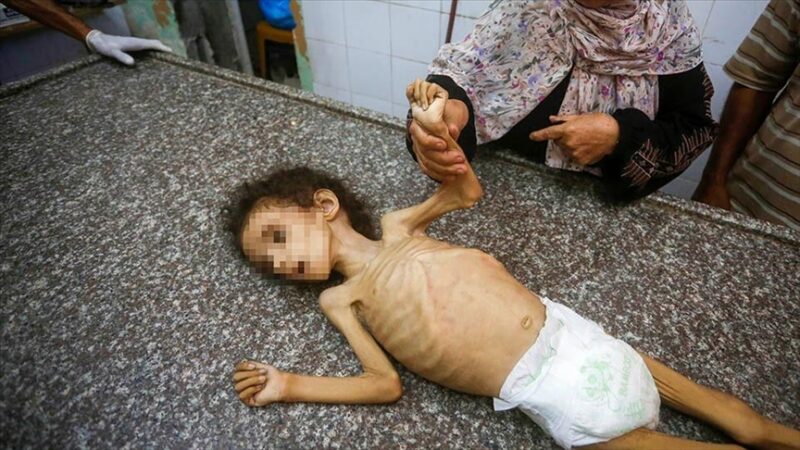 Gaza : Décès d'une fillette de 4 ans des suites de malnutrition, selon l'agence WAFA