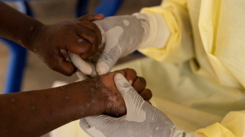 Variole du singe : Le Sénégal en alerte, un cas signalé en Gambie