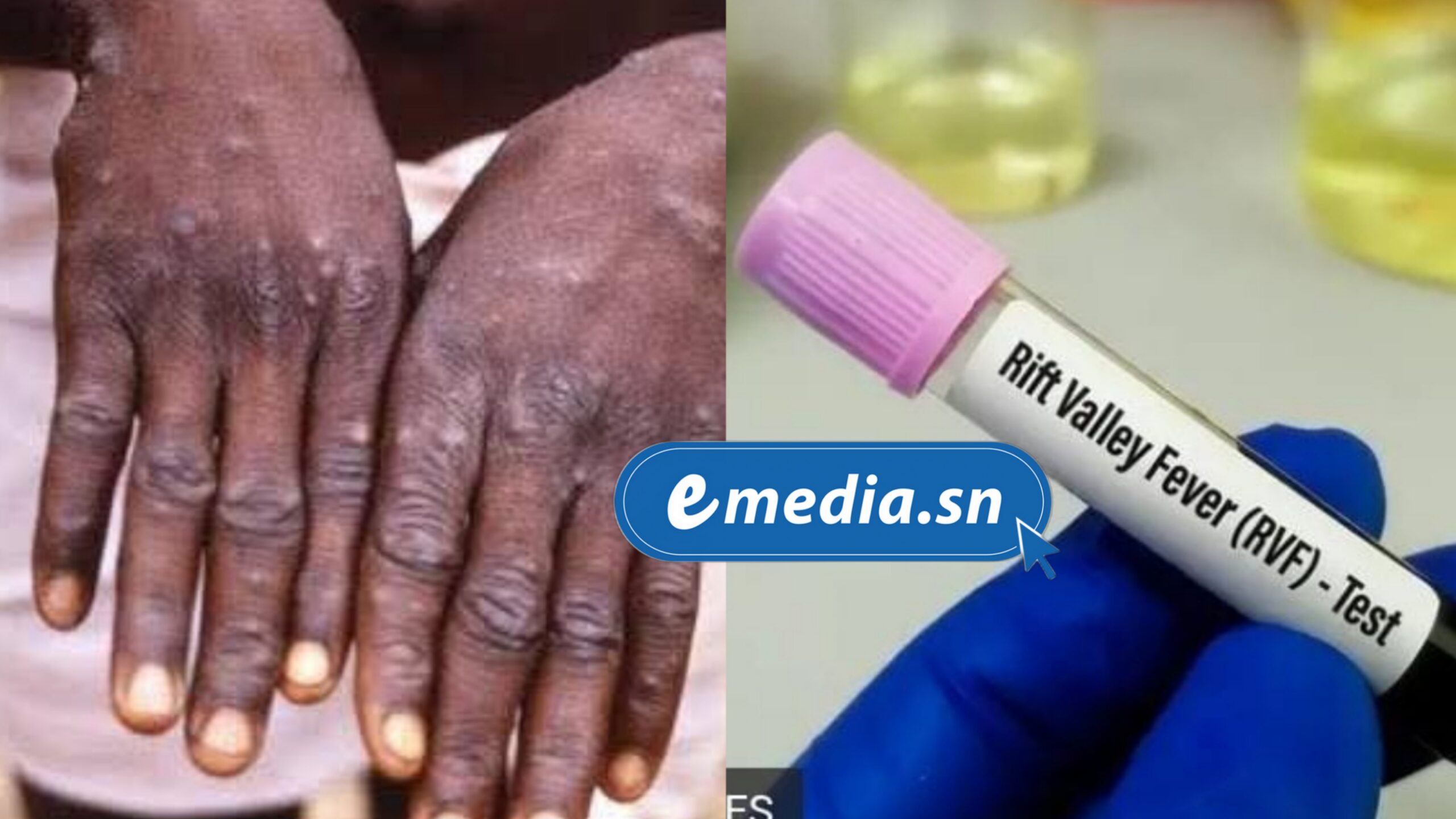 Épidémies au Sénégal : 8 décès dus à la Fièvre de la Vallée du Rift, 5 cas de Mpox recensés à Dakar