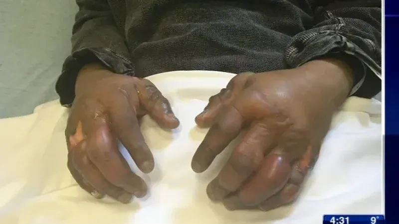 Sénégal – Drame de la jalousie à Touba : Condamnée à 6 mois ferme pour avoir ébouillanté son mari