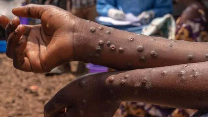 Épidémies, la Fièvre de la Vallée du Rift et Mpox  324 cas