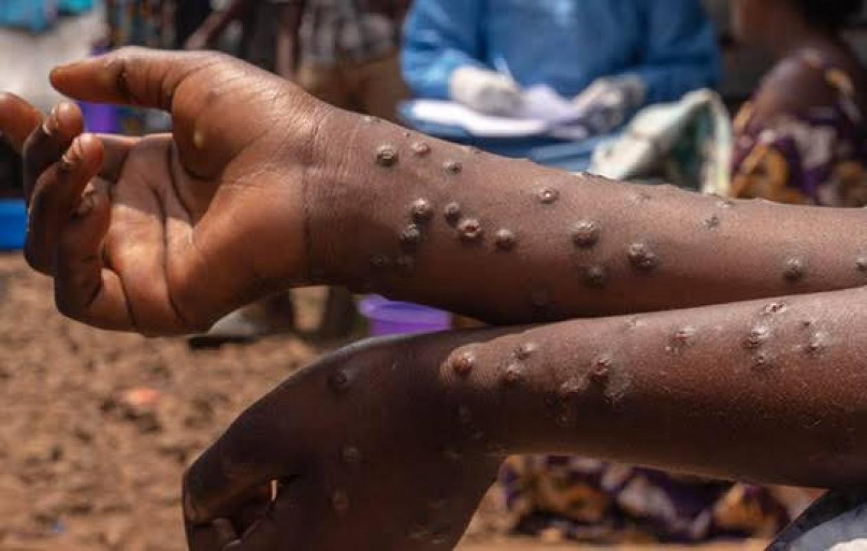 Épidémies, la Fièvre de la Vallée du Rift et Mpox  324 cas