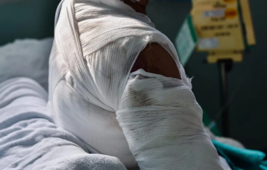 Richard-Toll : une femme ébouillante sa rivale, 21 jours d’incapacité temporaire de travail