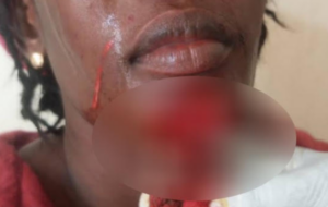 Coépouses en guerre à Méouane : Fatou Kiné Diop gravement blessée après une agression brutale