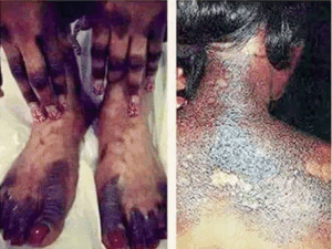 Dépigmentation : le Dr Ibrahima Ndiaye alerte sur les risques de diabète et d'hypertension