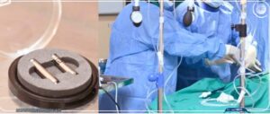 L’hôpital Idrissa Pouye réussit les premières implantations de pacemakers sans sonde en Afrique de l’Ouest