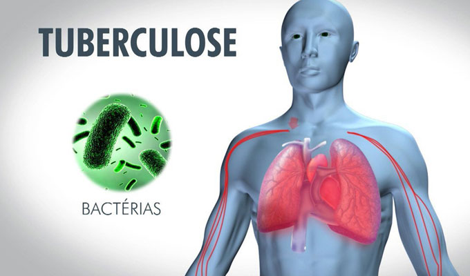 Tuberculose : L’alerte rouge est déclenchée à Touba